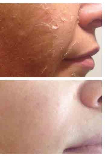 DOPORUČENÍ nejméně měsíc po proceduře neprovádějte žádný peeling své pleti až do pátého dne ošetření (Beauty Finish) nesmí přijít pokožka do