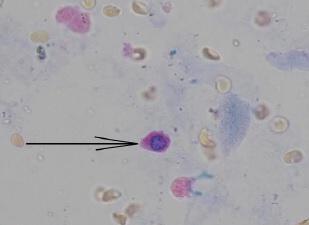 Fragmenty epitelií v uskupeních svědčí pro silné poškození tubulů. Nález renálních tubulárních epitelií v sedimentu hodnotíme vždy jako patologický, neboť ve fyziologických močích se nevyskytují.
