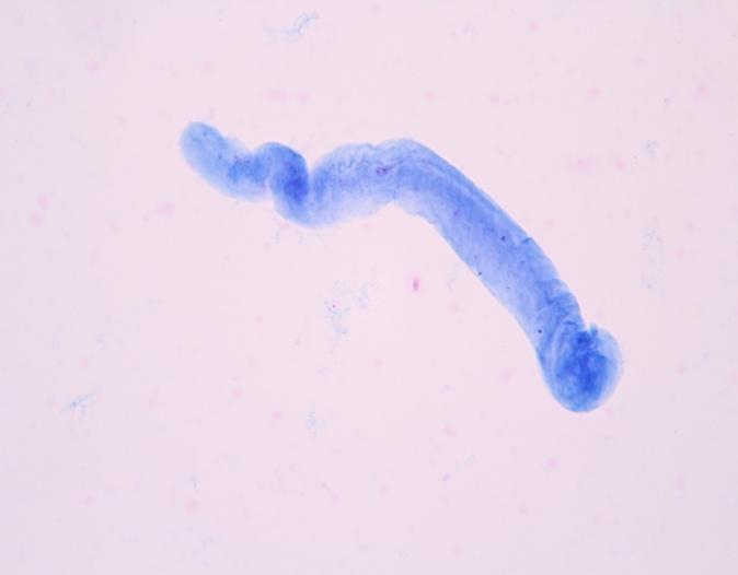 Obrázek 16 Hyalinní válec Granulované válce Granulované válce jsou druhým nejčastěji se vyskytujícím typem válců v močovém sedimentu.