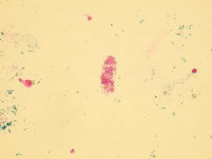 příznakem toxického či ischemického poškození ledvin, a proto nesmí být v sedimentu
