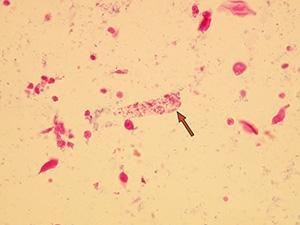 Obrázek 22 Bakteriální válec [34] Tukové válce Při poškození glomerulání membrány se do moče dostávají lipoproteinové částice, které jsou zpětně reabsorbovány tubulárními buňkami.