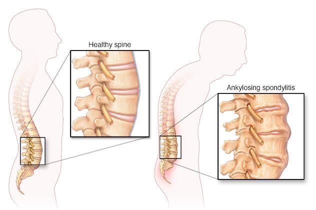 SI, postup kraniální, syndesmofyty, ankylosa páteře - revmatoidní artritida: