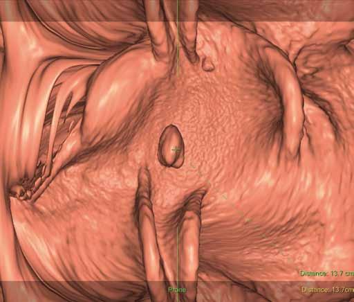 Mezinárodní doporučení ESGAR (European Society of Gastrointestinal and Abdominal Radiology) [3] pro přípravu tračníku k CTC jsou poměrně obecná, zahrnují dietní opatření v rozumném rozsahu a očistu