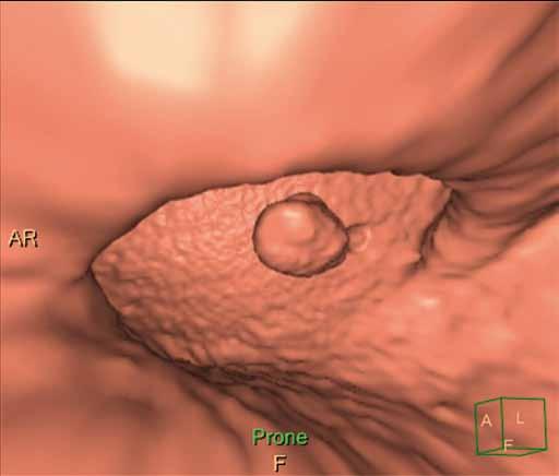Na našem pracovišti proto vycházíme z doporučení ESGE (European Society of Gastrointestinal Endoscopy) pro přípravu tračníku před koloskopií a v podstatě přejímáme závěry těchto doporučení.
