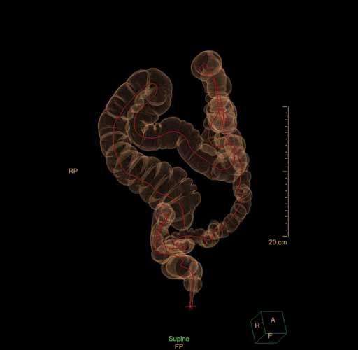 Partially collapsed sigmoid colon in prone position (A), fully distended sigmoid colon in supine position (same patient) (B). Tab. 2. C-RADS klasifikace. Tab. 2. C-RADS classification.