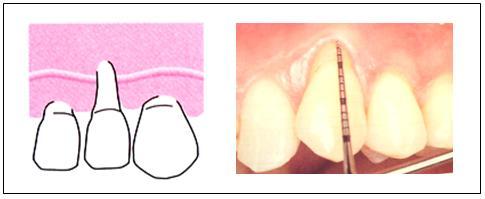 mají často zduřelou gingivu, která obnažení kořene kryje, proto se toto postižení objeví, až po odstranění zánětlivých změn gingivy.