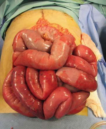 Variace chirurgického postupu open abdomen extenzivní laparotomie přichycení kožních okrajů svorkami zipovací systémy (Velcro burr) Bogota vak vacuum