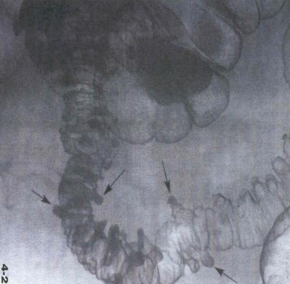 KOLITIDA ABDOMINÁLNÍ ANGINA LÉČBA FARMAKOLOGICKÁ MÁLO ÚSPĚŠNÁ, INTERVENČNÍ ZATÍM NEROZVINUTA DIVERTIKULÓZA ZÁNĚT,