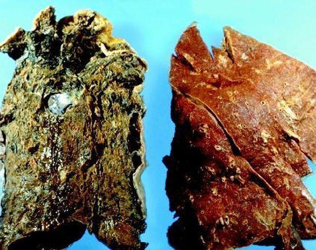 Příklad polymorfizmus enzymů GST a kouření glutathion S-transferázy (GST) představují rodinu proteinů, které katalyzují konjugaci redukovaného glutathionu s řadou hydrofobních látek obsahujících