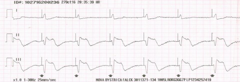 EKG počas kardiostimulácie PERKUTÁNNA KARDIOSTIMULÁCIA
