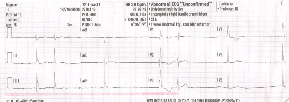 12 - zvodový EKG záznam PERKUTÁNNA KARDIOSTIMULÁCIA