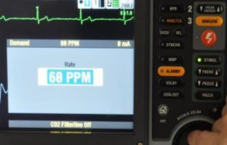 Realizované intervencie ZZ 20:04 O 2 15l/min maska s rezervoárom, kontinuálne 20:05 Atropin 500 ug i.v. 20:10 Atropin 500 ug i.v. 20:15 PACER anterolaterálne - RATE 60/min - CURRENT 60 ma 20:15 F1/1 500 ml i.