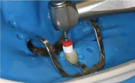Použití unikátní ultrazvukové technologie v oblasti endodoncie.