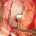 místech kde se běžně neimplantuje pomocí horizontálních distraktorů a rozšiřovačů kosti + následná implantace.