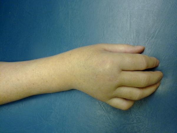 regulace. Na ruce se objevuje charakteristická krtkovitá změna prstů, které jsou špičatější ve srovnání se stavem před úrazem (viz obr. 1). Mění se rychlost růstu nehtů.