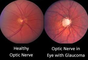 Obr. 3 Papila zrakového nervu u zdravého oka (vlevo) vs. u oka postiženého glaukomem https://www.glaucoma.org/treatment/optic-nerve-cupping.php, cit. 3. 4.