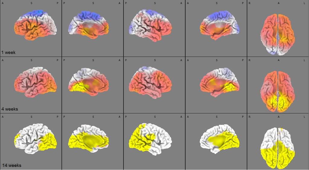 antidepresivní léčbou vedoucí k léčebnému efektu a ne jen pouhou změnou psychopatologie, ukazuje studie (Leuchter et al.