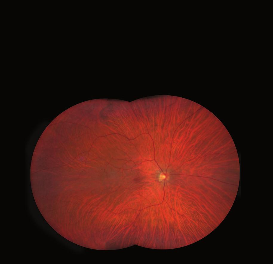 Imaging ultra-wide without compromise. ZEISS HD Ultra-widefield // INNOVATION MADE BY ZEISS ZEISS CLARUS 500 Color. Clarity.