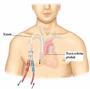 Co je to arterio-venózní štěp? Štěp (graft) je umělohmotná cévní protéza, vložená mezi tepnu a žílu na horní (výjimečně i na dolní) končetině.