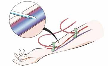 Jak pracuje má fistule/graft během dialýzy? Během dialýzy jsou zavedené do spojky dvě jehly. Jednou jehlou (červenou) se z těla odvádí krev, aby se vyčistila, a druhou (modrou) se očištěná vrací zpět.