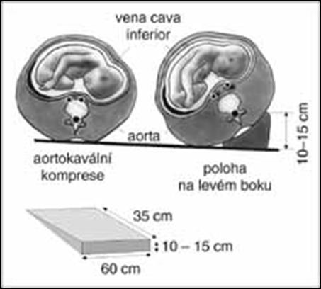 Kardiopulmonální resuscitace těhotných Do 24. týdne jako netěhotné V 20.- 23. g.t. je vhodná urgentní SC k umožnění efektivní KPR matky, nikoli k záchraně plodu Po 24.