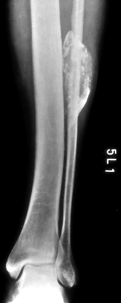 Myositis ossificans