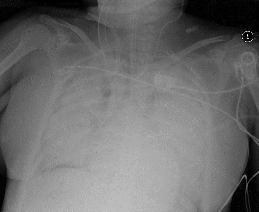 infekce = jedna z nejčastějších příčin morbidity a mortality