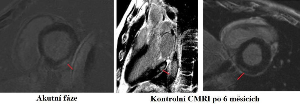 Obrázek 11: CMRI 17letého chlapce s 2. atakou akutní myokarditidy, výraznými bolestmi na hrudi, elevací troponinu a stoupajícím CRP.