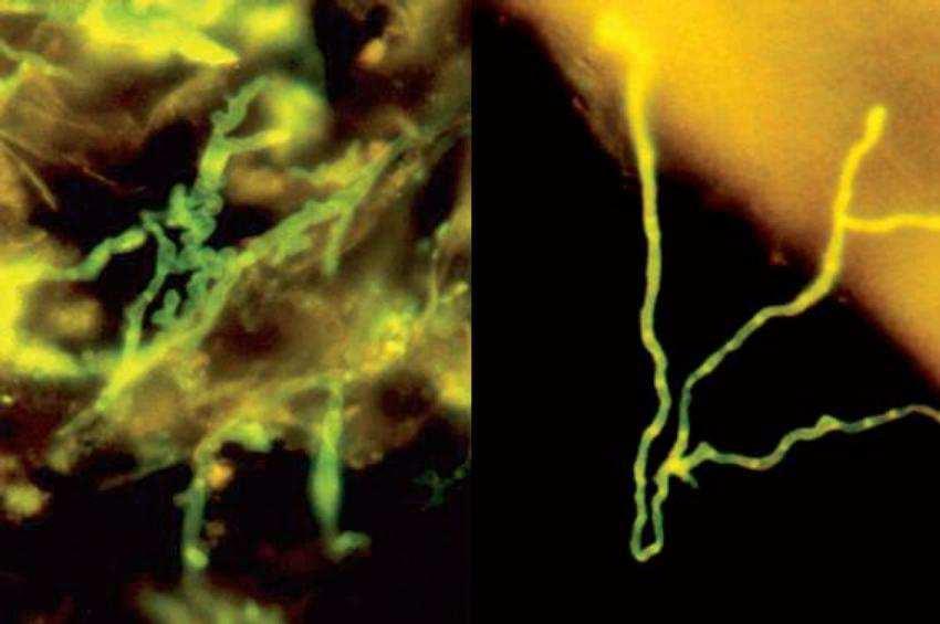 Aspergilózy Hyfy mikroskopických hub při fluorescenčním vyšetření