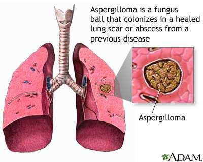 Aspergilózy Aspergilom u pacientů s preexistujícími dutinami v plících aspergilom je projevem saprofytické kolonizace plicních dutin vzniklých většinou po prodělané plicní tuberkulóze, z rozpadlého