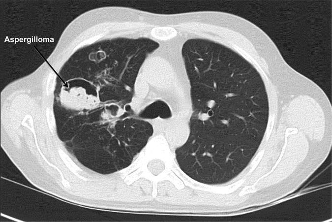 Aspergilózy Aspergilom - diagnostika rentgen nebo CT hrudníku kultivace ze sputa je pozitivní jen v 50 %