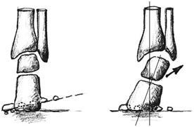 2.6 Typologie nohy V běţném ţivotě jsou uţívány termíny kvadratická (polynéská) noha, řecká a egyptská noha. U těchto názvu je uţito tzv.
