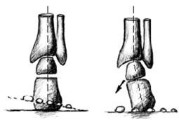 Obr. 7: Varózní postavení přednoţí (https://www.fyzioklinika.cz/clanky-ozdravi/klinicka-typologie-nohy-dle-mertona-l-roota-aneb-mate-dobre-nejen-postavenihlezennich-kloubu) Obr.