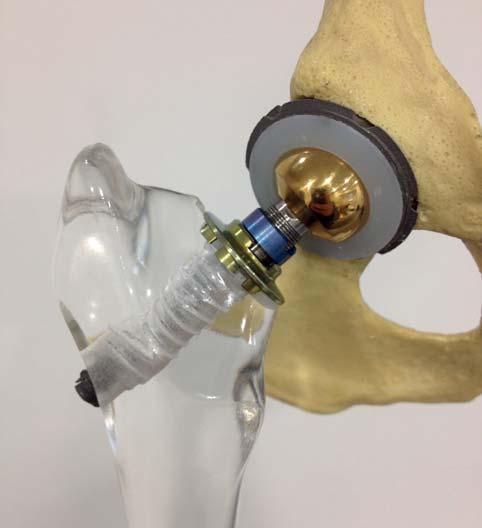was resolved conservatively with manual reduction. In one case the stem was incidentally placed in 7 anteversion, which caused a fissure and subsequent perforation of the caudal cortex of the femur.