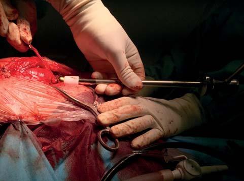 Obr. 12 Nasazení finální hlavice na krček dříku Perioperační medikace obsahovala amoxicillin clavulanát 20 mg/kg IV, enrofloxacin