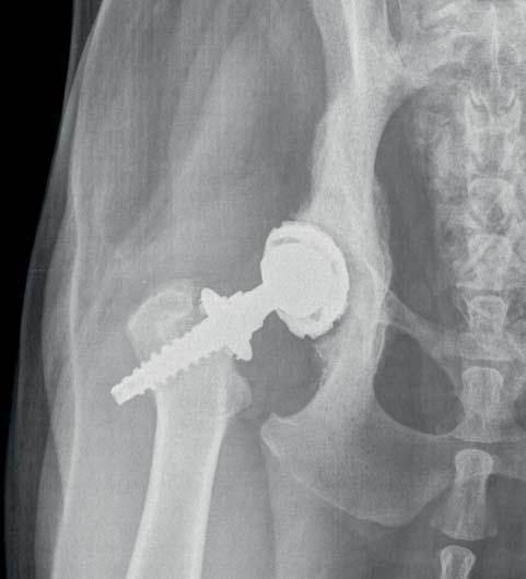 Aspirace neprokázala aktivní infekci implantátu, přesto došlo během dalších šesti týdnů k pozvolnému uvolnění acetabulárního implantátu (obr. 19).