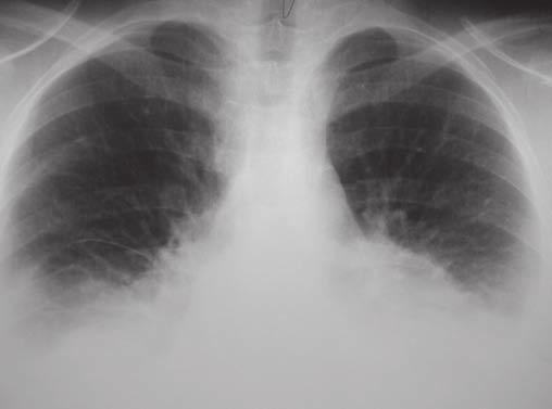 CHYLOTORAX KOMPLIKOVANÝ A RARITNÝ PREJAV SYSTÉMOVÉHO LUPUS ERYTHEMATOSUS Tab. č. 2: Analýza pleurálneho výpotku pri SLE (Walters 1993) SLE.