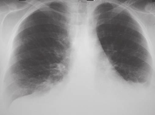 CHYLOTORAX KOMPLIKOVANÝ A RARITNÝ PREJAV SYSTÉMOVÉHO LUPUS ERYTHEMATOSUS Tab. č.