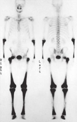 Klinicky se nemoc projevuje přítomností diabetes insipidus, kostní bolestí, únavou, váhovým úbytkem, exoftalmem, syndromem cerebelární dysfunkce a xantomy, hlavně na očních víčkách.