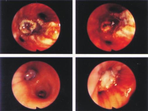 ZAJÍMAVÉ BRONCHOLOGICKÉ (A MORFOLOGICKÉ) NÁLEZY Všechny excidované hmoty byly odeslány k histologickému vyšetření.