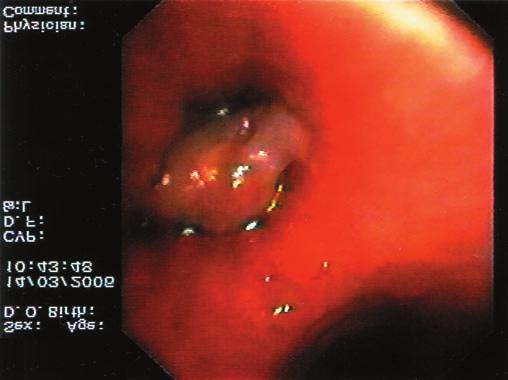 2006 Fragmenty fibrinózně hnisavé pablány s velkou účastí eozinofilních segmentovaných leukocytů. Hodnotitelné tkáňové fragmenty nezastiženy. Nález je nediagnostický.