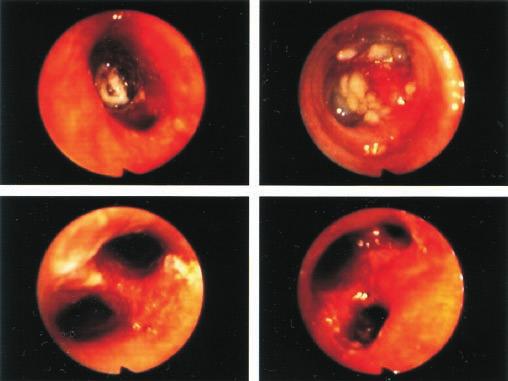 ZAJÍMAVÉ BRONCHOLOGICKÉ (A MORFOLOGICKÉ) NÁLEZY Obr. 17 Obr. 18 a b rekanalizovaná periferie dol. lob. br. sin. a b c bazální segment. a subsegment. br. sin. d c B 10 sin. d 9 8 Obr. 19 Obr. 20 hor.