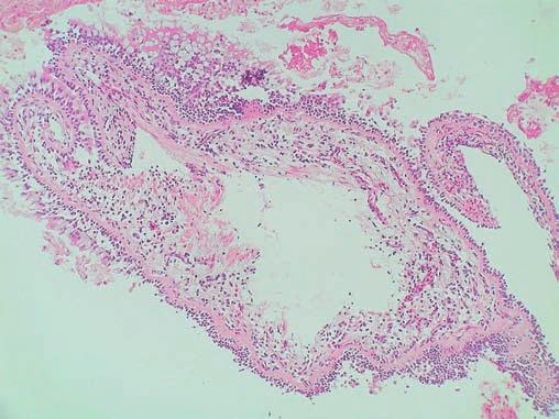 příčinách endobronchiálních nálezů. Literatura: Kašák, V. Prevence a léčba asthma bronchiale. Medicína po promoci 5, č. 3: 74 80, 2004. Udaya, B. S. Prakash (ed.) Bronchoscopy.