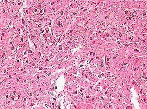 ABRIKOSOVOV TUMOR P ÚC (GRANULAR CELL TUMOR) Obr. č. 1: Abrikosovov tumor p úc histologický nález. Tumor je zložený z ve kých buniek, v cytoplazme sú hojné granulá, ktoré sú PAS pozitívne.