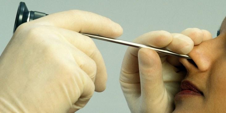 Přímá rhinoendoksopie http://www.