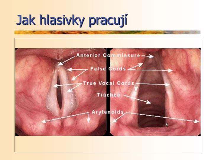 Extraezofagfeální reflux aspekce arytenoidních hrbolů MUDr.