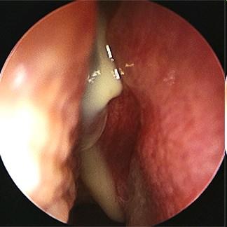 Etiologie - sinusitis S.pneumoniae H.influenzae Moraxella catharhalis Staphyloc.aureus Aspergilus fumig. Laibl.