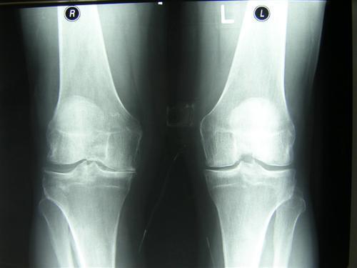 Osteoarthrosis nezánětlivé onemocnění kloubu destrukce kloubní