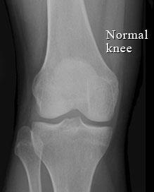 com/knee-paindiagnosis-xray.html http://www.wrosc.