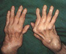 Arthritis zánětlivé onemocnění kloubu autoimunitní (revmatická, psoriatická)